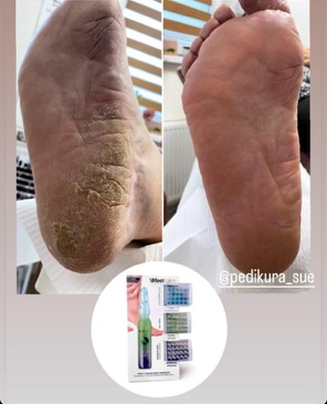 Before/After - Hyperkeratosis