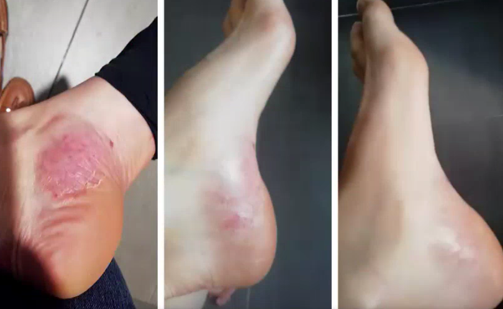 Skin Mycosis - Before/After