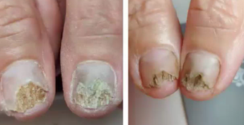 Nail Mycosis