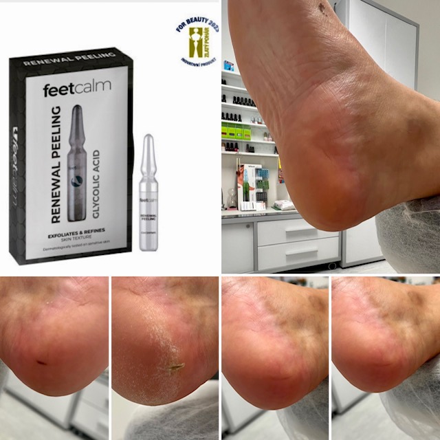 Before/After - Peeling Concentrate