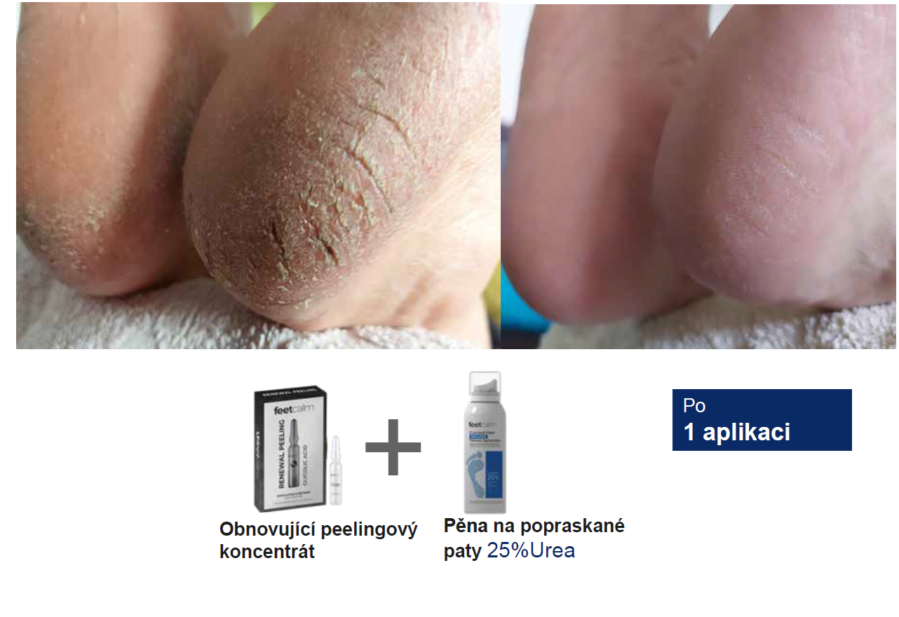 Before/After - Cracked Heels