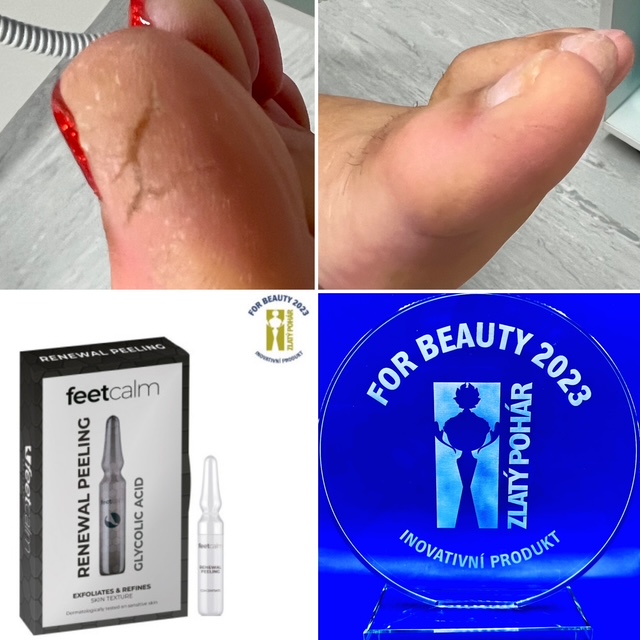 Renewal Peeling + Before/After