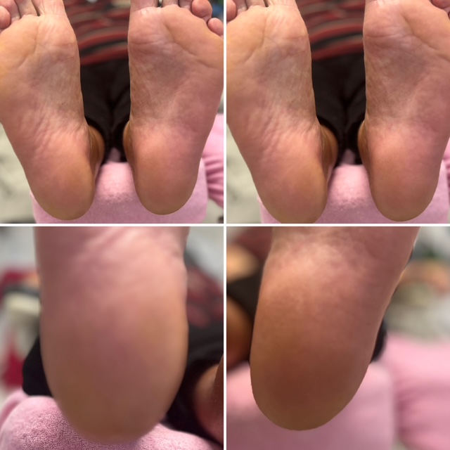 Before/After - Dry Skin