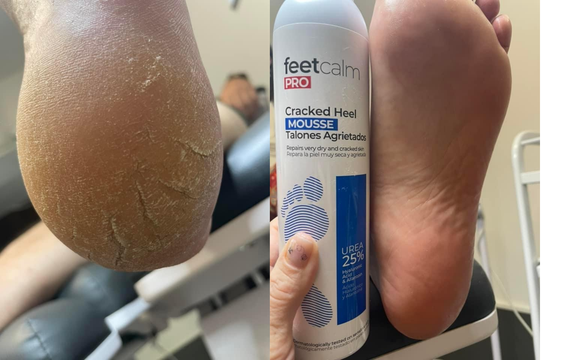 Before/After - Cracked Heels